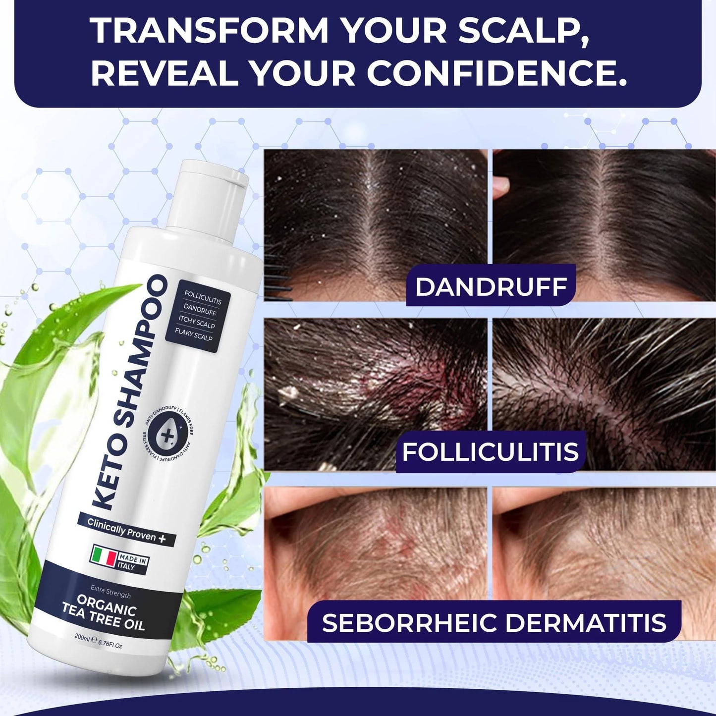 Anti Dandruff Shampoo Pack 2 with Scalp Brush Sulfate Free Medicated Clarifying